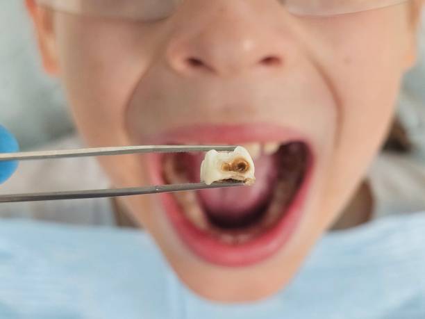 Best Knocked-Out Tooth (Avulsed Tooth) Treatment in Garden City Park, NY